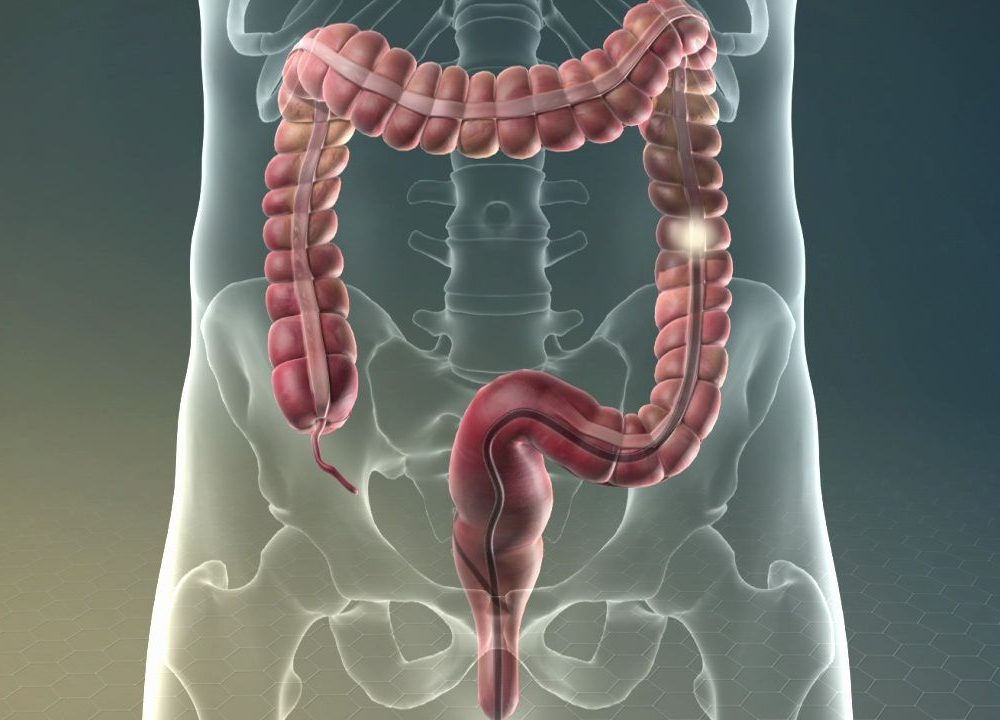 colonoscopy_1280