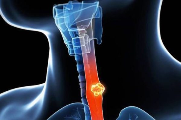 esophagus